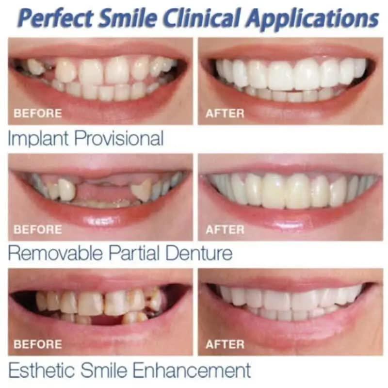 Snap On Fake Teeth White ABS Comfort Fit